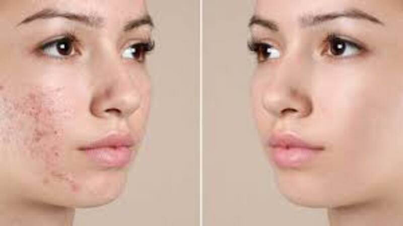 Bị Mụn Có Peel Da Được Không? Hướng Dẫn An Toàn 7 Chăm sóc da sau peel da để giảm mụn trứng cá (Nguồn: Internet)