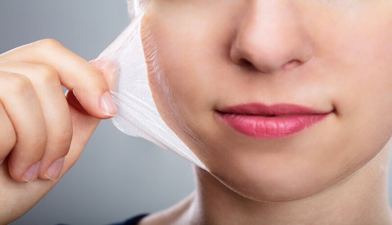7 phương pháp điều trị nám hiệu quả nhất dành cho bạn 11 Peel da là phương pháp điều trị nám hiệu quả nhất bằng cách loại bỏ lớp da chết và da bị nám ở bề mặt (Nguồn: Internet)