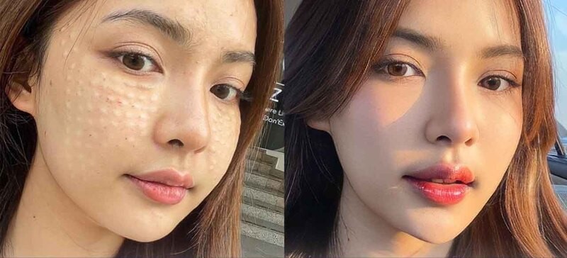 Phương Pháp Tiêm Meso Điều Trị Mụn Cho Làn Da Sạch Mụn, Trẻ Hóa 7 Phương pháp tiêm meso điều trị mụn là gì? (Nguồn: Internet)