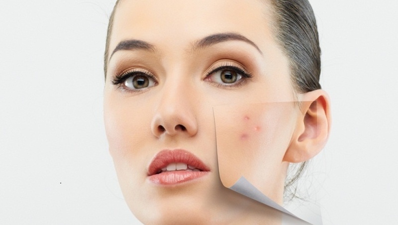 Phương Pháp Tiêm Meso Điều Trị Mụn Cho Làn Da Sạch Mụn, Trẻ Hóa 8 Phương pháp tiêm meso trị mụn đang dần trở thành "cứu cánh" cho những ai đang gặp vấn đề về mụn (Nguồn: Internet)