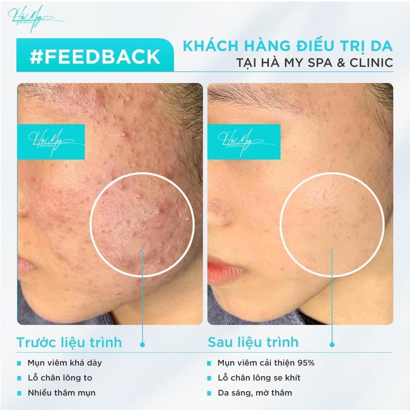 Phương Pháp Tiêm Meso Điều Trị Mụn Cho Làn Da Sạch Mụn, Trẻ Hóa 12 Khách hàng tin tưởng tiêm meso điều trị mụn tại Hà My Spa (Nguồn: Hà My Spa)