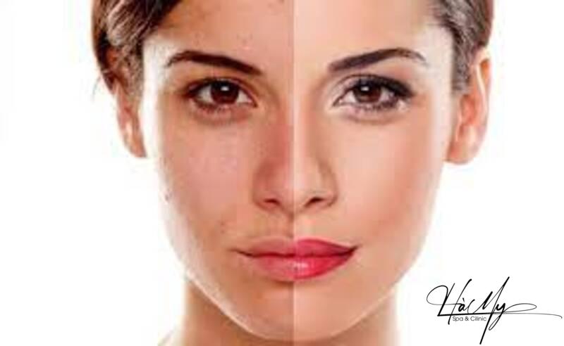 5 Địa chỉ spa peel da trị nám Hà Tĩnh uy tín nhất 7 Trước và sau khi peed da trị nám (Nguồn: Internet)