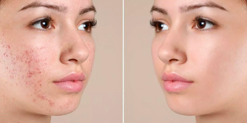 Tiêm meso bị lên mụn thì phải làm sao? 5 Tiêm meso là một phương pháp thẩm mỹ không xâm lấn (Nguồn: Internet)