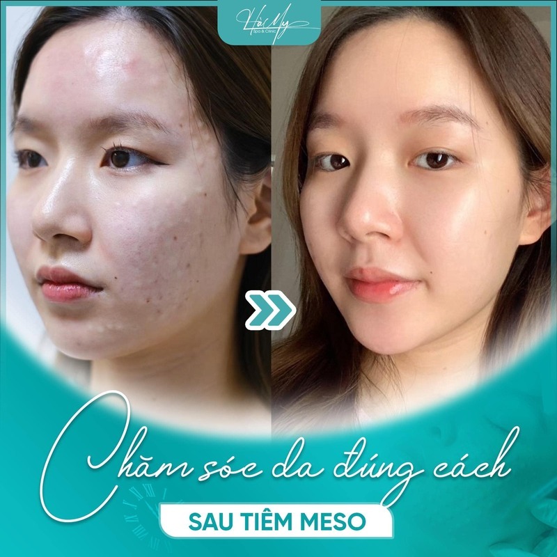 Tiêm meso bị lên mụn thì phải làm sao? 8 Hà My Spa & Clinic cung cấp dịch vụ tiêm meso an toàn và hiệu quả (Nguồn: Hà My Spa)