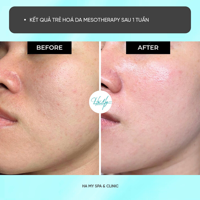 Tiêm Meso trắng da - Phương pháp cho làn da trắng sáng mịn màng 12 Nâng tầm nhan sắc với dịch vụ tiêm meso trắng da tại Hà My Spa (Nguồn: Hà My Spa)