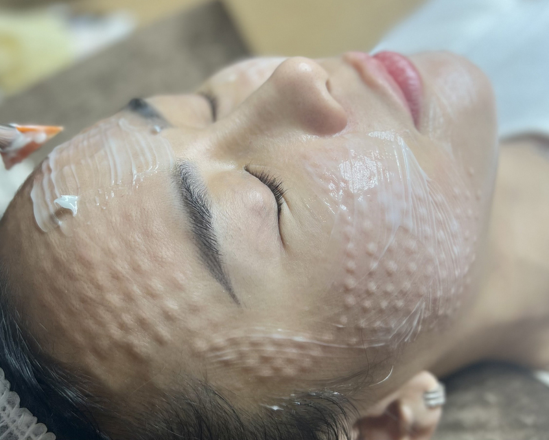 Tiêm meso và HA là gì? Khi nào nên chọn tiêm meso hoặc HA 5 Tiêm meso và HA là gì không phải ai cũng biết (Nguồn: Internet)