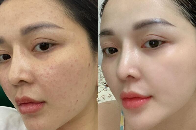 Tiêm meso và HA là gì? Khi nào nên chọn tiêm meso hoặc HA 6 Tiêm meso và HA mang lại nhiều lợi ích cho vẻ đẹp làn da (Nguồn: Internet)