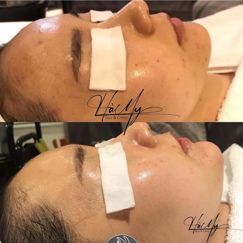 Tiêm meso và HA là gì? Khi nào nên chọn tiêm meso hoặc HA 8 Hà My Spa & Clinic có đội ngũ chuyên gia giàu kinh nghiệm về tiêm meso (Nguồn: Hà My Spa)