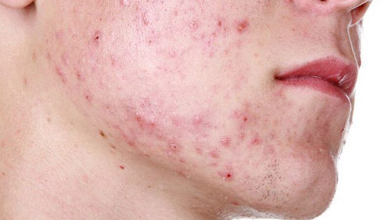 Những cách trị mụn cho nam hiệu quả nhất - Trị mụn tại Hà My Spa 7 Nam giới thường có nguy cơ bị mụn (Nguồn: Internet)