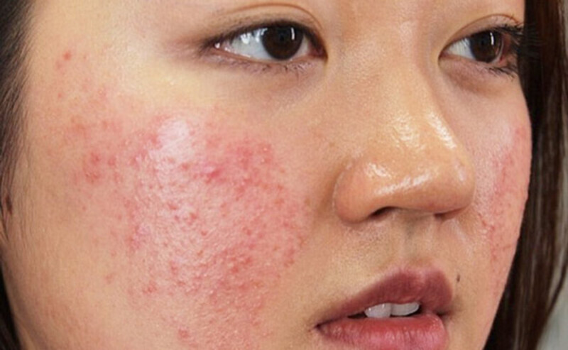 Viêm nang lông ở mặt: Hướng dẫn điều trị và phòng ngừa hiệu quả 6 Viêm nang lông ở mặt là gì? (Nguồn: Internet)
