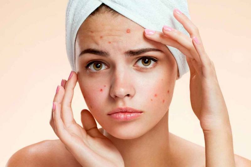 Ăn Gì Để Hết Mụn: Bí Quyết Dẹp Tan Nỗi Ám Ảnh 8 Ăn gì để hết mụn là câu hỏi khiến nhiều người trăn trở (Nguồn: Internet)
