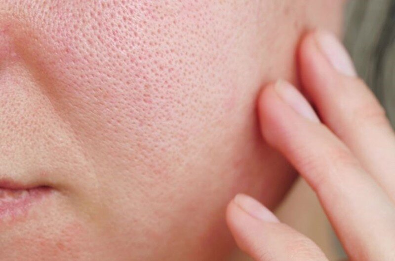 Bị Mụn Ẩn Mãi Không Khỏi? Đã Có Giải Pháp Hiệu Quả Ngay Tại Đây! 11 Lỗ chân lông to là một trong những dấu hiệu của mụn ẩn (Nguồn: Internet)
