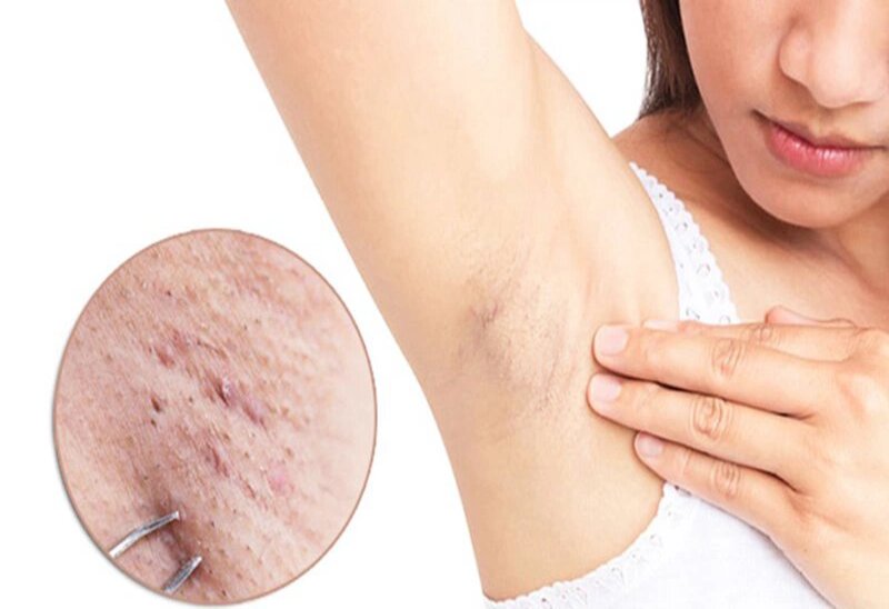 Cách Chữa Trị Mụn Thịt Trên Mặt Đơn Giản, Hiệu Quả 10 Mụn thịt ở nách khiến ta tự ti (Nguồn: Internet)