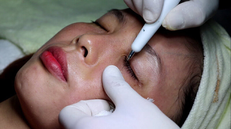 Cách Chữa Trị Mụn Thịt Trên Mặt Đơn Giản, Hiệu Quả 12 Cách chữa trị mụn thịt trên mặt bằng đốt điện cao tần (Nguồn: Internet)