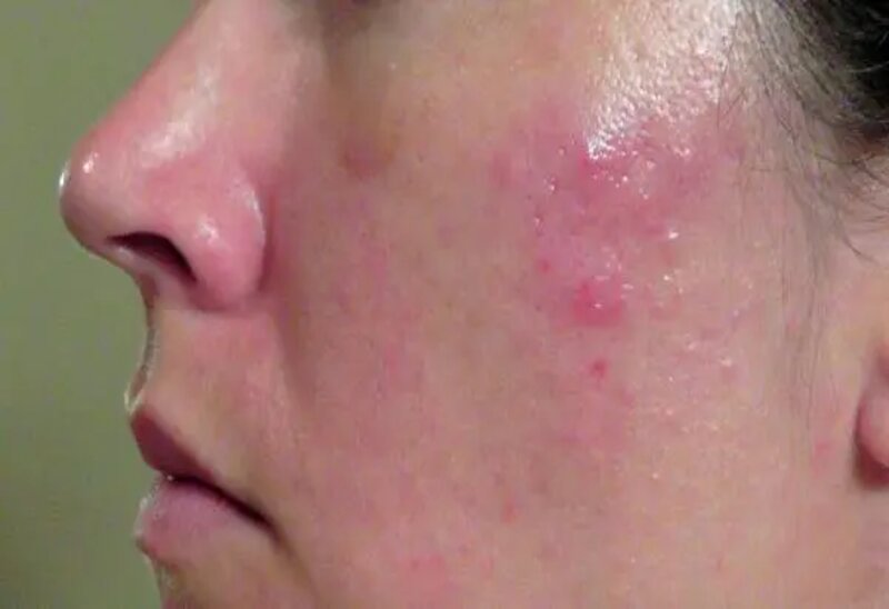 Cách Trị Mụn Ẩn Ở Má: Bí Quyết Cho Làn Da Mịn Màng 12 Tăng tiết bã nhờn là nguyên nhân hàng đầu làm nổi mụn ẩn (Nguồn: Internet)