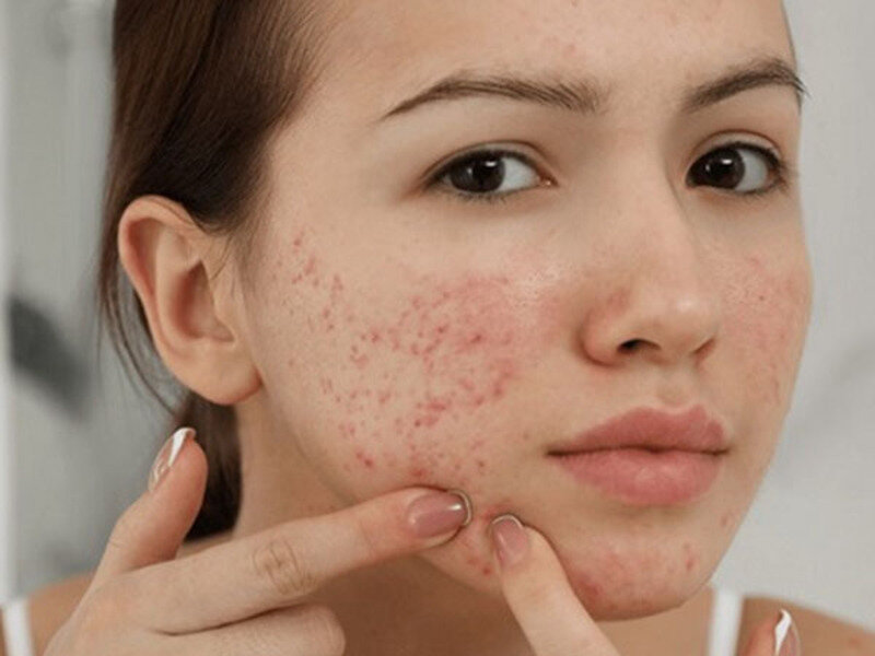 Cách Trị Mụn Ẩn Ở Má: Bí Quyết Cho Làn Da Mịn Màng 13 Dùng tay nặn mụn là điều cấm kỵ cho làn da của bạn (Nguồn: Internet)