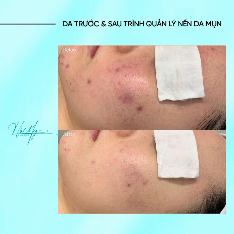 Cách Trị Mụn Ẩn Ở Má: Bí Quyết Cho Làn Da Mịn Màng 18 Điều trị mụn ẩn ở má tại Hamy Spa (Nguồn: Hamy Spa)