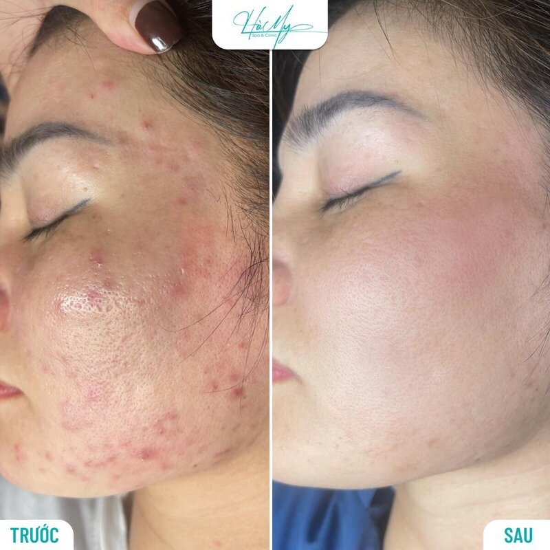 Cách Trị Mụn Bọc Sưng Đỏ Hiệu Quả: Hướng Dẫn A-Z 2024 18 Trước và sau khi điều trị mụn bọc sưng đỏ tại Hamy Spa (Nguồn: Hamy Spa)