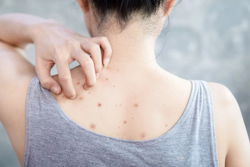 Cách Trị Mụn Lưng Hiệu Quả Cho Cả Nam Lẫn Nữ 13 Mụn lưng gây mất thẩm mỹ (Nguồn: Internet)