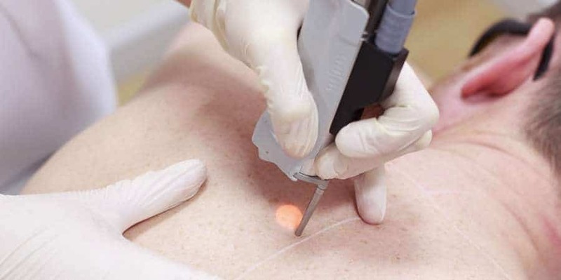 Cách Trị Mụn Lưng Hiệu Quả Cho Cả Nam Lẫn Nữ 16 Cách trị mụn lưng bằng phương pháp thẩm mỹ (Nguồn: Internet)