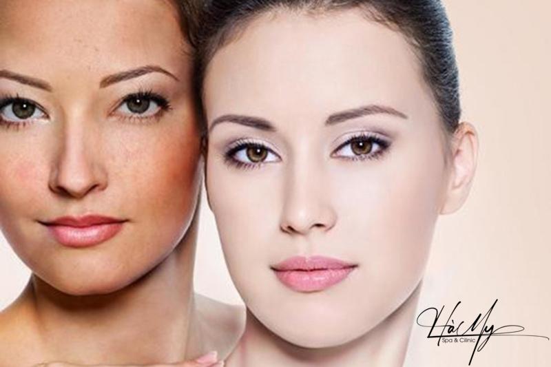 Dịch vụ trị nám đốm nâu tại Hà My Spa (Nguồn: Hà My Spa)