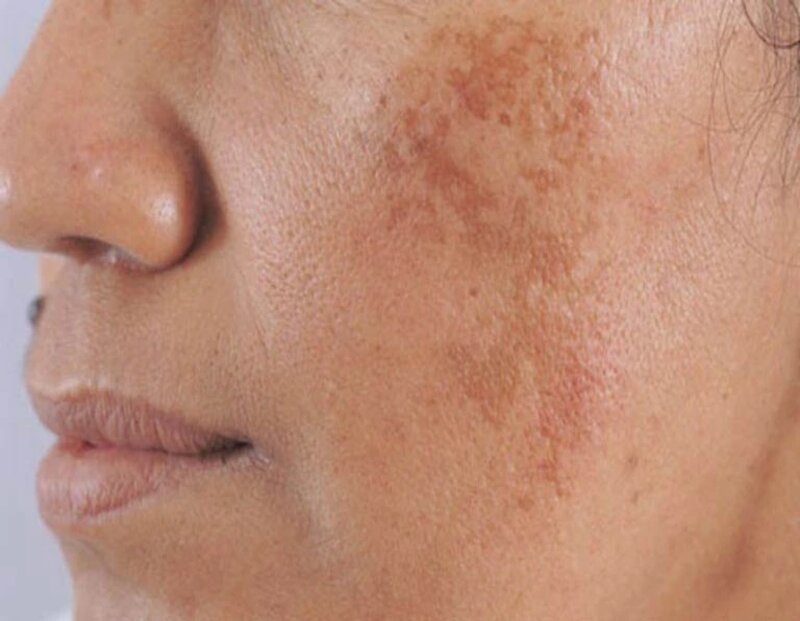 Công Nghệ Điều Trị Nám Melas White Plus Có Gì Hot? 8 Nám da gây mất tự tin, thẩm mỹ cần được loại bỏ (Nguồn: Internet)