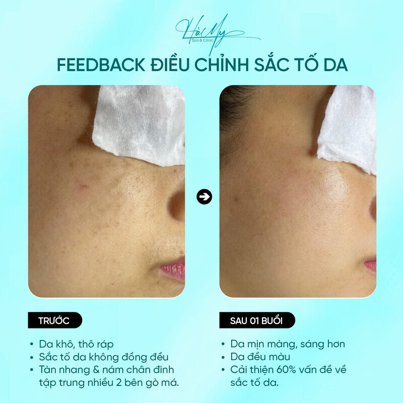 Công Nghệ Điều Trị Nám Melas White Plus Có Gì Hot? 12 Feedback điều trị nám bằng công nghệ điều trị nám Melas White Plus tại Hamy Spa (Nguồn: Hamy Spa)