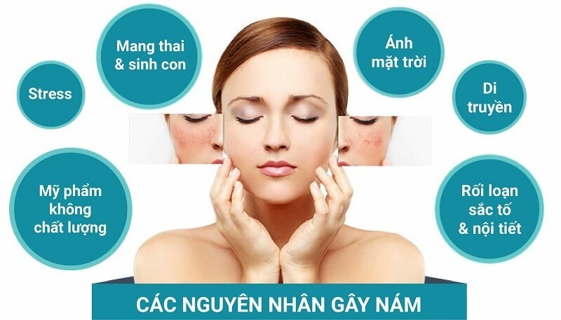 Da Sạm Màu Bất Thường - Kẻ Thù Của Làn Da Rạng Rỡ 8 Nguyên nhân gây nám da (Nguồn: Internet)