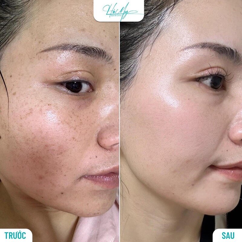 Da Sạm Màu Bất Thường - Kẻ Thù Của Làn Da Rạng Rỡ 10 Trước và sau khi trị nám, tàn nhang, đồi mồi tại Hamy Spa (Nguồn: Internet)
