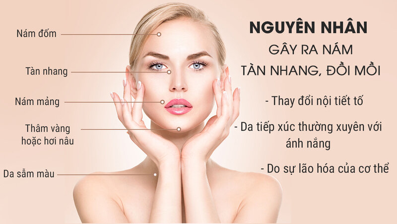 Kinh Nghiệm Trị Nám Tại Spa - Cẩm Nang Vàng Cho Làn Da Sáng Mịn 6 Nguyên nhân gây ra nám da (Nguồn: Internet)