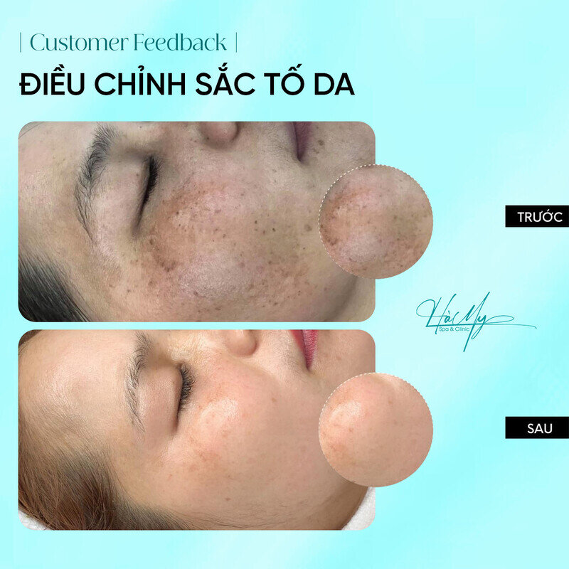 Kinh Nghiệm Trị Nám Tại Spa - Cẩm Nang Vàng Cho Làn Da Sáng Mịn 7 Da căng bóng mịn màng sau khi điều trị tại Hamy Spa (Nguồn: Hamy Spa)