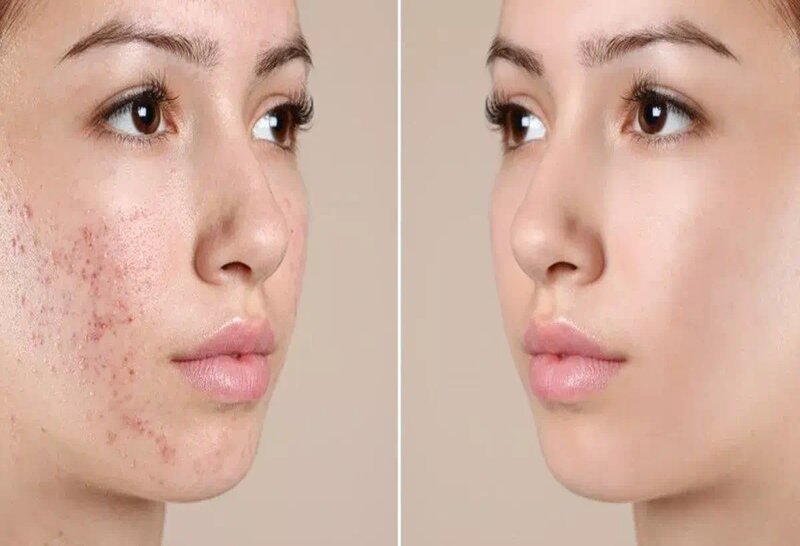 Mụn Li Ti Trên Mặt - Nỗi Ám Ảnh Không Của Riêng Ai 34 Da mặt trước và sau khi điều trị mụn li ti trên mặt (Nguồn: Internet)