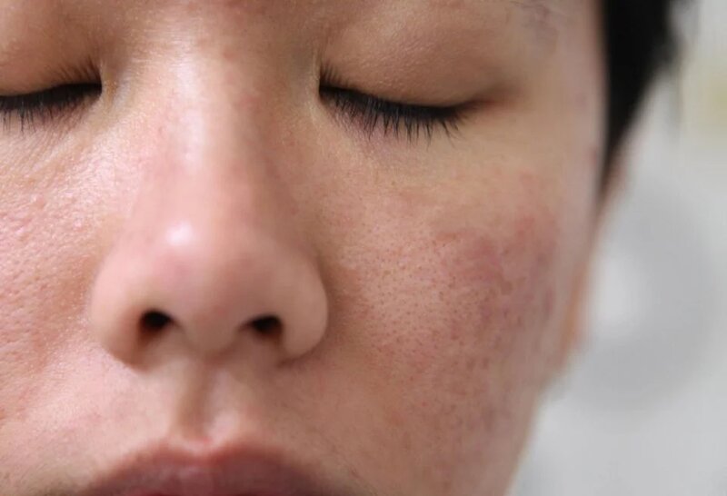 Mụn Li Ti Trên Mặt - Nỗi Ám Ảnh Không Của Riêng Ai 19 Hình ảnh da sần sùi, lỗ chân lông to (Nguồn: Internet)