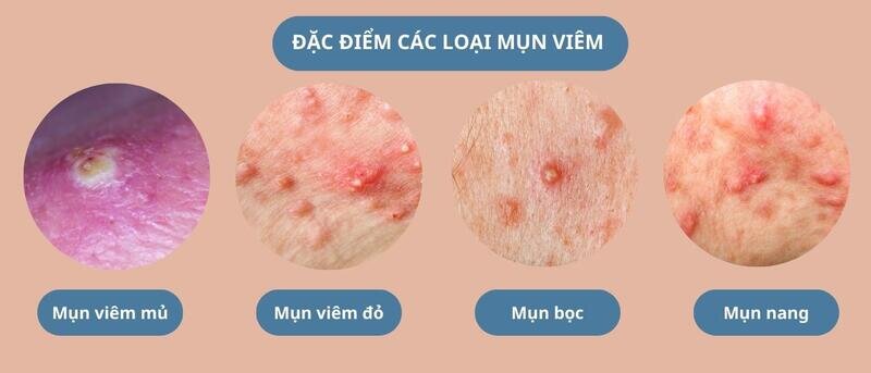 Mụn Viêm Có Nên Nặn Không? Giải Pháp Chuyên Gia khuyên Dành Cho Bạn! 9 Cách phân biệt các loại mụn viêm (Nguồn: Internet)
