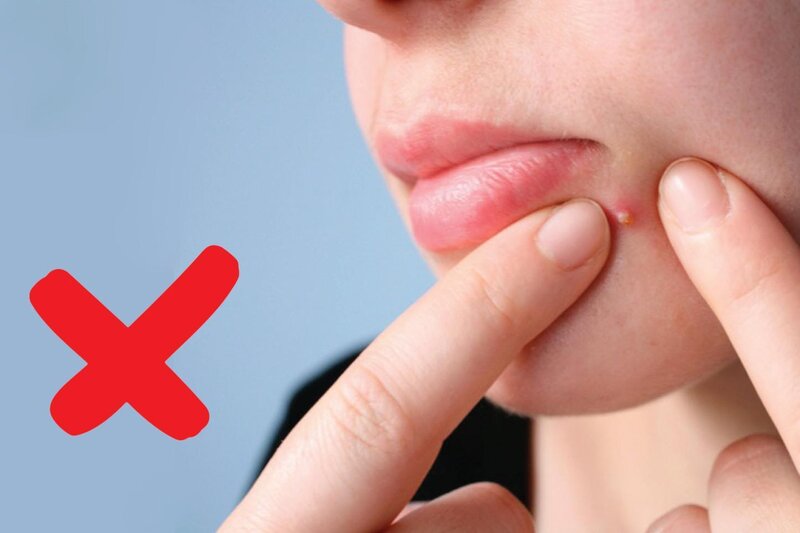 Mụn Viêm Có Nên Nặn Không? Giải Pháp Chuyên Gia khuyên Dành Cho Bạn! 11 Bị mụn viêm có nên nặn không? (Nguồn: Internet)