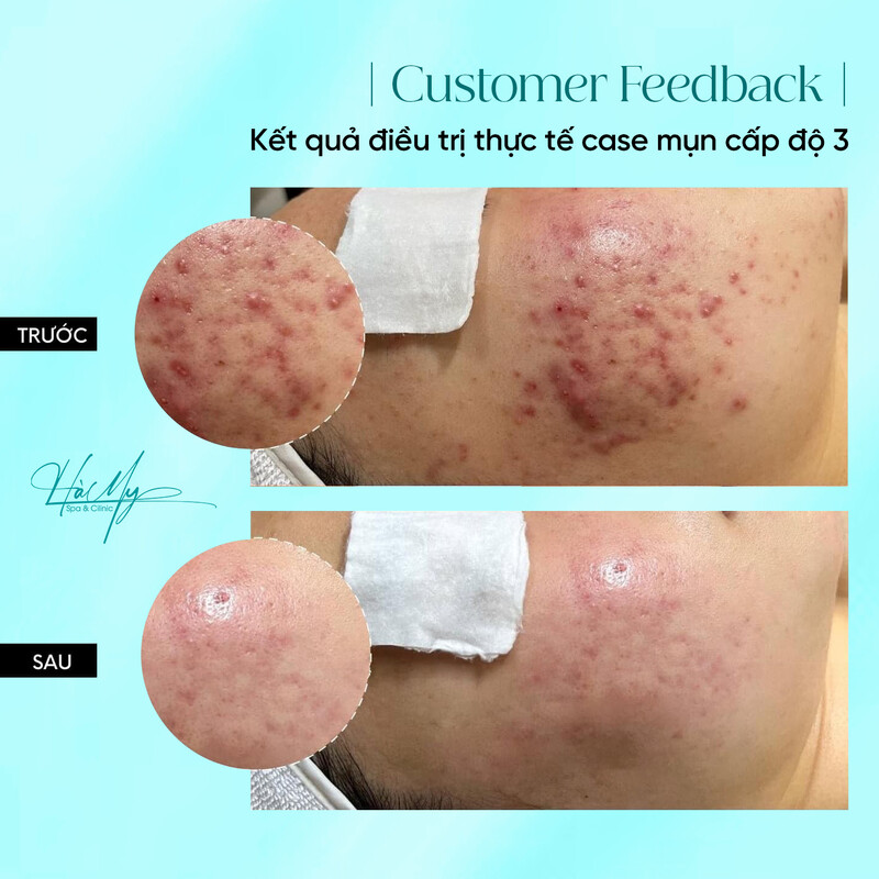 Mụn Viêm Có Nên Nặn Không? Giải Pháp Chuyên Gia khuyên Dành Cho Bạn! 12 Điều trị mụn viêm cấp độ 3 tại Hà My Spa (Nguồn: Hà My Spa)