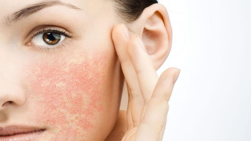 Sữa Rửa Mặt Dược Mỹ Phẩm - Nền Tảng Cho Làn Da Khỏe Đẹp 13 Da nhạy cảm là gì? (Nguồn: Internet)