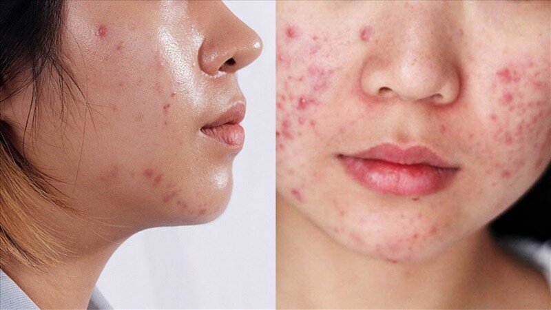 Sữa Rửa Mặt Dược Mỹ Phẩm - Nền Tảng Cho Làn Da Khỏe Đẹp 14 Như thế nào là da dầu mụn? (Nguồn: Internet)