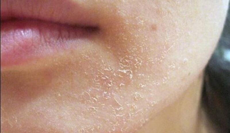 Sữa Rửa Mặt Dược Mỹ Phẩm - Nền Tảng Cho Làn Da Khỏe Đẹp 15 Da khô là gì? (Nguồn: Internet)