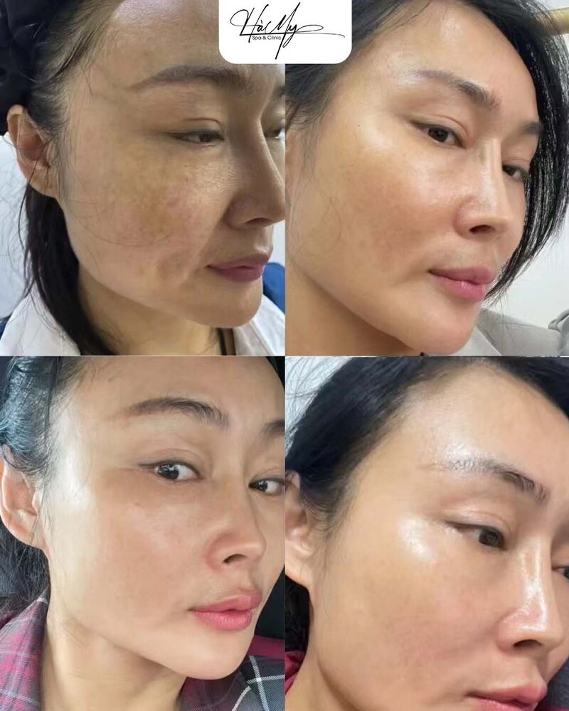 Sau khi điều trị nám da - Bí quyết để tự tin (Nguồn: Hamy Spa)