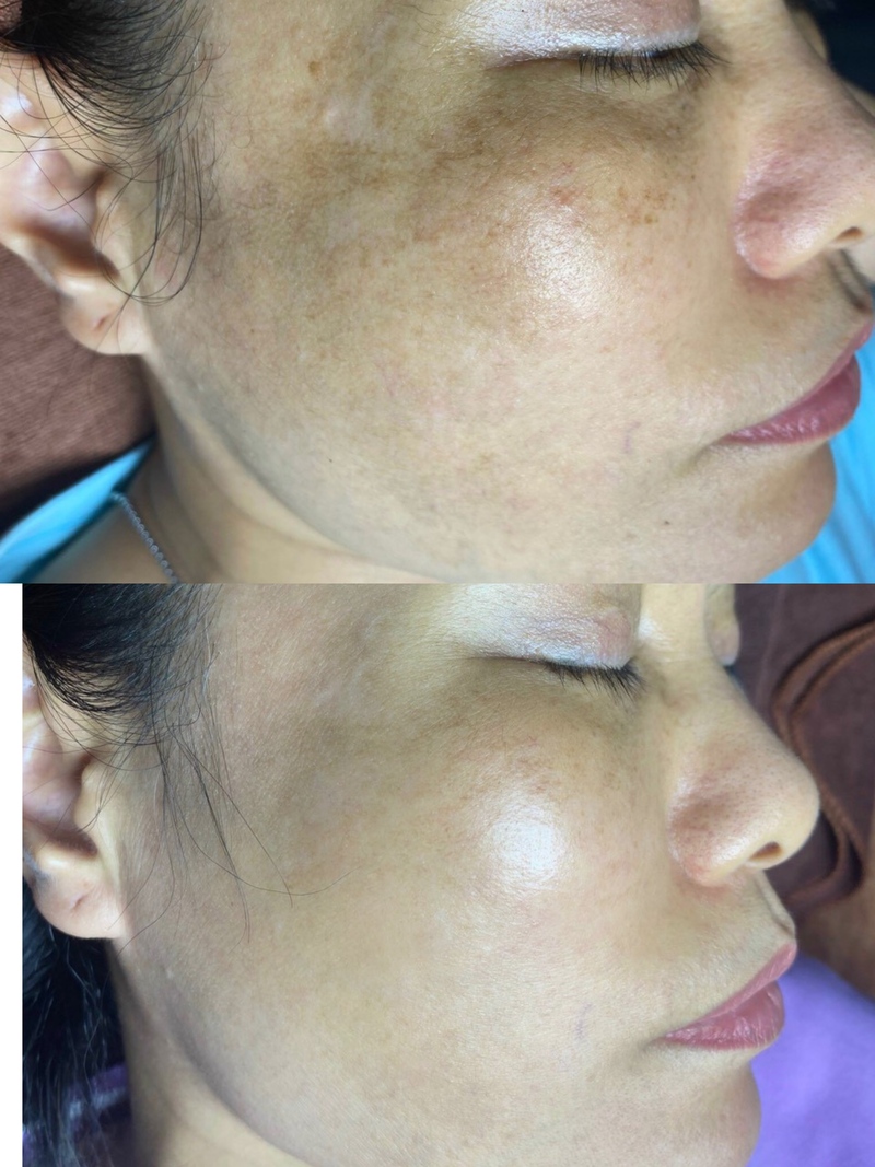 Trước và sau khi điều trị nám tại Hamy Spa (Nguồn: Hamy Spa)