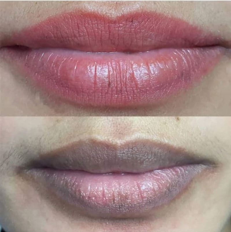 Xăm Môi 1 Tháng Vẫn Thâm? Đừng Lo! Đây Là Giải Pháp! 9 Môi sưng tấy, bầm tím là biểu hiện bình thường sau khi xăm môi (Nguồn: Internet)