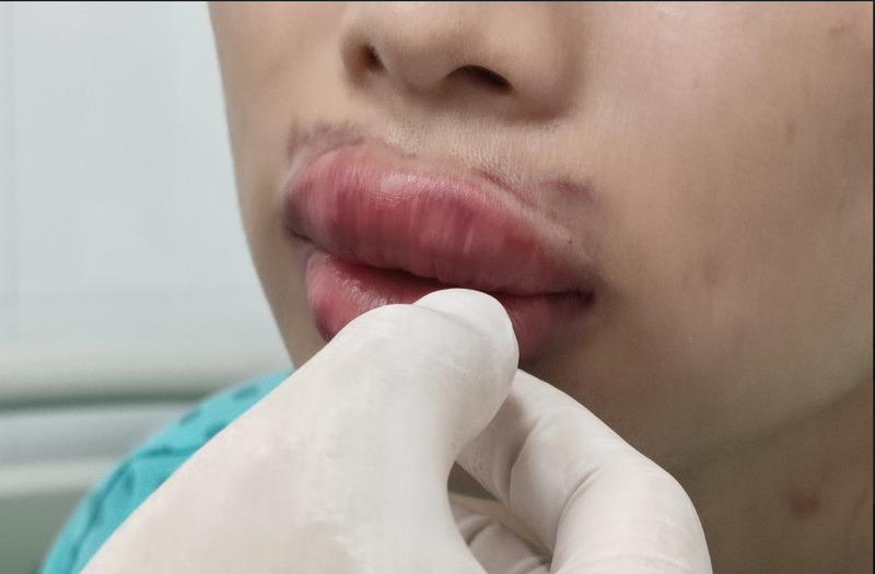 Trường hợp biến chứng nghiêm trọng cần được điều trị kịp thời (Nguồn: Internet)