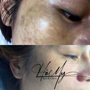 Da trắng hồng, hết nám sau khi trị tại Hamy Spa (Nguồn: Hamy Spa & Clinic)