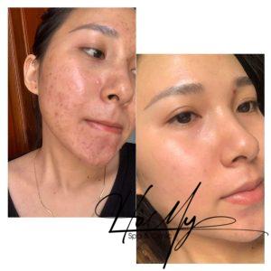 Hiệu quả tiêm Meso trị mụn (Nguồn: Hamy Spa)