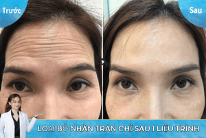 Khách tiêm xóa nếp nhăn trán tại Hamy Spa (Nguồn: Hamy Spa)