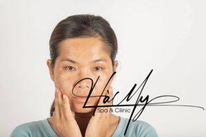 Nám da là một trong những vấn đề làm đẹp thường gặp ở phụ nữ, đặc biệt là những người có tuổi (Nguồn: Internet)