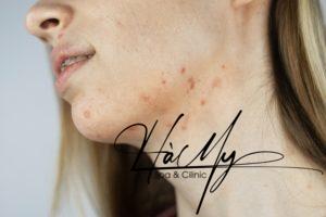 Nổi mụn ở cằm là do tăng hormone androgen (Nguồn: Internet)