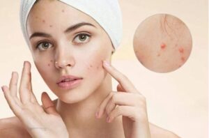 Kiên nhẫn và kiên trì sử dụng thuốc trị mụn bọc hiệu quả sẽ trị hết mụn bọc (Nguồn: Internet)