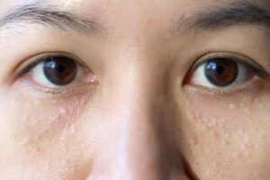 Mụn thịt như thế nào? (Nguồn: Internet)